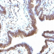 IHC testing of FFPE human ovarian carcinoma and EMI-1 antibody (clone FBXP5). Staining of formalin-fixed tissues requires boiling tissue sections in pH 9 10mM Tris with 1mM EDTA for 10-20 min followed by cooling at RT for 20 min.