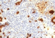 IHC testing of FFPE human Hodgkin's lymphoma and CD15 antibody (clone CDLA15-1).