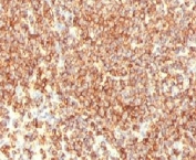 IHC staining of FFPE human lymphoma tissue with CD20 antibody (clone CDLA20-1). HIER: boil tissue sections in pH6, 10mM citrate buffer, for 10-20 min and allow to cool before testing.