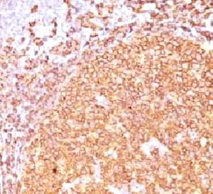 IHC staining of FFPE human tonsil tissue with CD20 antibody (clone CDLA20-1). HIER: boil tissue sections in pH6, 10mM citrate buffer, for 10-20 min and allow to cool before testing.~