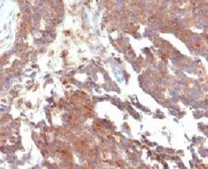 IHC testing of FFPE human ovarian carcinoma and GnRHR antibody (clone LCHR37). Staining of formalin-fixed tissues requires boiling tissue sections in 10mM Tris with 1mM EDTA, pH 9, for 10-20 min followed by cooling at RT for 20 min.~