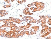 IHC testing of FFPE human breast carcinoma with Basic Cytokeratin antibody (clone BCCK1-1).