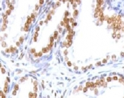 IHC testing of FFPE human prostate carcinoma and Androgen Receptor antibody (clone ANDRC-1).