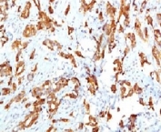 IHC testing of FFPE human breast carcinoma and HSP27 antibody (clone SRPR27). Staining of formalin-fixed tissues requires boiling tissue sections in pH 9 10mM Tris with 1mM EDTA for 10-20 min followed by cooling at RT for 20 min.