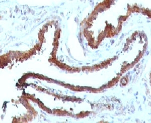 IHC testing of FFPE human prostate carcinoma and HSP27 antibody (clone SRPR27). Staining of formalin-fixed tissues requires boiling tissue sections in pH 9 10mM Tris with 1mM EDTA for 10-20 min followed by cooling at RT for 20 min.~