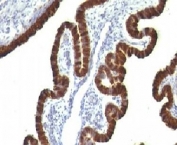 IHC testing of human ovarian carcinoma and Cytokeratin 7 antibody (clone CTKN7-1). Staining of formalin-fixed tissues requires boiling tissue sections in pH 9 10mM Tris with 1mM EDTA for 10-20 min followed by cooling at RT for 20 minutes.