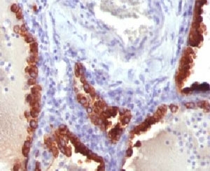 IHC testing of FFPE human lung carcinoma and Cytokeratin 7 antibody (clone CTKN7-1). Staining of formalin-fixed tissues requires boiling tissue sections in pH 9 10mM Tris with 1mM EDTA for 10-20 min followed by cooling at RT for 20 minutes.~