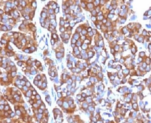 IHC testing of FFPE human melanoma with Moesin antibody (clone EDLP70). HIER: steam section in pH6 citrate buffer for 20 min.~
