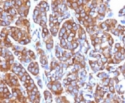 IHC testing of FFPE human melanoma with Moesin antibody (clone EDLP70). HIER: steam section in pH6 citrate buffer for 20 min.