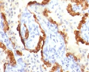 IHC testing of FFPE human lung carcinoma and Cytokeratin 18 antibody (clone CTKN18-1). FFPE testing requires sections to be boiled in pH 9 10mM Tris with 1mM EDTA for 10-20 min, followed by cooling at RT for 20 min, prior to staining.~