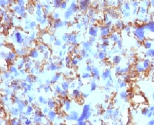 IHC testing of FFPE human histiocytoma and HLA-DRB1 antibody (clone MHDRb2). Staining of formalin-fixed tissues is enhanced by boiling tissue sections in pH 9 10mM Tris with 1mM EDTA for 10-20 min followed by cooling at RT for 20 min.