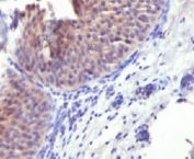 IHC testing of FFPE human bladder carcinoma and Keratin 10 antibody. Staining of formalin-fixed tissues requires boiling tissue sections in pH 9 10mM Tris with 1mM EDTA for 10-20 min followed by cooling at RT for 20 min.