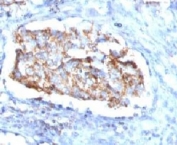IHC testing of FFPE human lung carcinoma and HSP60 antibody (clone SRPR60). Staining of formalin-fixed tissues requires boiling tissue sections in pH 9 10mM Tris with 1mM EDTA for 10-20 min followed by cooling at RT for 20 min.