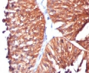 IHC testing of FFPE human bladder carcinoma and HSP60 antibody (clone SRPR60). Staining of formalin-fixed tissues requires boiling tissue sections in pH 9 10mM Tris with 1mM EDTA for 10-20 min followed by cooling at RT for 20 min.