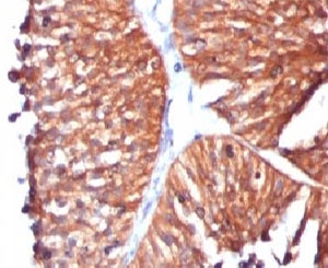 IHC testing of FFPE human bladder carcinoma and HSP60 antibody (clone SRPR60). Staining of formalin-fixed tissues requires boiling tissue sections in pH 9 10mM Tris with 1mM EDTA for 10-20 min followed by cooling at RT for 20 min.~