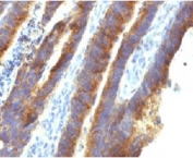 IHC testing of FFPE human colon carcinoma with MUC3 antibody (clone MUCN3-1). Staining of formalin-fixed tissues requires boiling tissue sections in pH 9 10mM Tris with 1mM EDTA for 10-20 min followed by cooling at RT for 20 min.