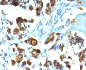 IHC testing of FFPE human gastric carcinoma with MUC3 antibody (clone MUCN3-1). Staining of formalin-fixed tissues requires boiling tissue sections in pH 9 10mM Tris with 1mM EDTA for 10-20 min followed by cooling at RT for 20 min.~