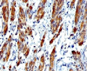 IHC testing of FFPE human Leiomyosarcoma with SMMHC antibody (clone SMM11-1). FFPE testing requires sections to be boiled in pH 9 10mM Tris with 1mM EDTA for 10-20 minutes, followed by cooling at RT for 20 minutes, prior to staining.~
