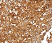 IHC testing of FFPE human melanoma with B2M antibody (clone MGBP2-1). FFPE testing requires sections to be boiled inpH 9 10mM Tris with 1mM EDTA for 10-20 minutes, followed by cooling at RT for 20 minutes, prior to staining.
