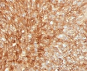 IHC testing of FFPE human bladder carcinoma with B2M antibody (clone MGBP2-1). FFPE testing requires sections to be boiled inpH 9 10mM Tris with 1mM EDTA for 10-20 minutes, followed by cooling at RT for 20 minutes, prior to staining.