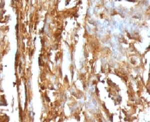 IHC testing of FFPE human renal carcinoma with B2M antibody (clone MGBP2-1). FFPE testing requires sections to be boiled inpH 9 10mM Tris with 1mM EDTA for 10-20 minutes, followed by cooling at RT for 20 minutes, prior to staining.~
