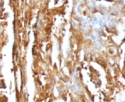 IHC testing of FFPE human renal carcinoma with B2M antibody (clone MGBP2-1).  FFPE testing requires sections to be boiled inpH 9 10mM Tris with 1mM EDTA for 10-20 minutes, followed by cooling at RT for 20 minutes, prior to staining.