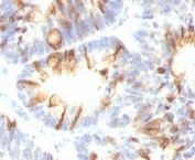 IHC testing of FFPE human colon carcinoma with MUC2 antibody (clone MLP/842). Staining of formalin-fixed tissues requires boiling tissue sections in 10mM Tris-HCl buffer, pH 10 for 10-20 min followed by cooling at RT for 20 minutes.