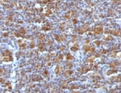 IHC testing of FFPE Hodgkin's Lymphoma with Bax antibody (clone ARBX-1)