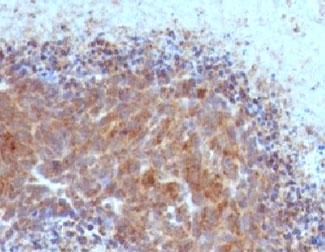 IHC testing of FFPE human melanoma with Bax antibody (clone ARBX-1)~