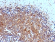 IHC testing of FFPE human melanoma with Bax antibody (clone ARBX-1)
