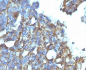 IHC testing of FFPE human ovarian carcinoma and CD99 antibody (clone CDLA99). Staining of formalin-fixed tissues requires boiling tissue sections in pH 9 10mM Tris with 1mM EDTA for 10-20 min followed by cooling at RT for 20 min.