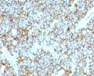 IHC testing of FFPE human Ewing's sarcoma and CD99 antibody (clone CDLA99). Staining of formalin-fixed tissues requires boiling tissue sections in pH 9 10mM Tris with 1mM EDTA for 10-20 min followed by cooling at RT for 20 min.~