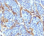 IHC testing of FFPE human melanoma with CD271 antibody (clone CDLA271).