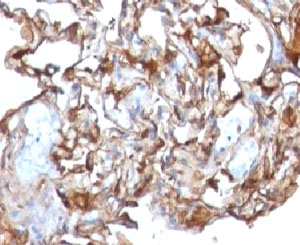 IHC testing of human melanoma and CD146 antibody (clone CDLA146)~