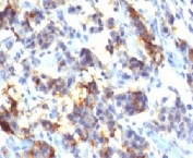 IHC testing of FFPE human gastric carcinoma with MUC5AC antibody (clone MUCN5AC). Staining of formalin-fixed tissues requires boiling tissue sections in pH 9 10mM Tris with 1mM EDTA for 10-20 min followed by cooling at RT for 20 min.