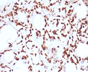 IHC testing of FFPE human angiosarcoma and Histone H1 antibody (clone OSHT-2). Staining of formalin/paraffin tissues requires boiling tissue sections in pH 9 10mM Tris with 1mM EDTA for 10-20 min followed by cooling at RT for 20 min.~