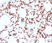 IHC testing of FFPE human angiosarcoma and Histone H1 antibody (clone OSHT-2). Staining of formalin/paraffin tissues requires boiling tissue sections in pH 9 10mM Tris with 1mM EDTA for 10-20 min followed by cooling at RT for 20 min.