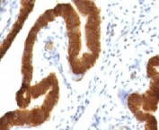 IHC testing of FFPE human ovarian carcinoma and Keratin 19 antibody (clone CTKN19-1). FFPE testing requires sections to be boiled in pH 9 10mM Tris with 1mM EDTA for 10-20 minutes, followed by cooling at RT for 20 minutes, prior to staining.