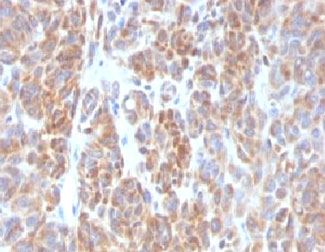 IHC testing of FFPE human melanoma with Bcl2 antibody (clone ARBC2-1). HIER: boil tissue sections in 10mM Tris with 1mM EDTA, pH 9, for 10-20 min and allow to cool before testing.~