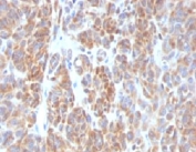 IHC testing of FFPE human melanoma with Bcl2 antibody (clone ARBC2-1). HIER: boil tissue sections in 10mM Tris with 1mM EDTA, pH 9, for 10-20 min and allow to cool before testing.