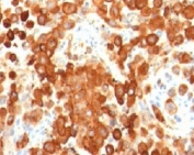 IHC testing of human melanoma with PMEL17 antibody (clone MSSG95). HIER: boil tissue sections in pH 9 10mM Tris with 1mM EDTA for 20 min and allow to cool before testing.