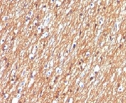 IHC testing of FFPE human brain tumor with CD56 antibody (clone CDLA56).