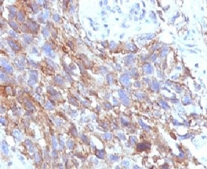 IHC testing of FFPE human lung carcinoma with CD56 antibody.~
