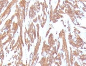 IHC testing of FFPE human leiomyosarcoma with Smooth Muscle Actin antibody (clone SMAT2-1). Staining of formalin-fixed tissues requires boiling tissue sections in pH 9 10mM Tris with 1mM EDTA for 10-20 min followed by cooling at RT for 20 min.