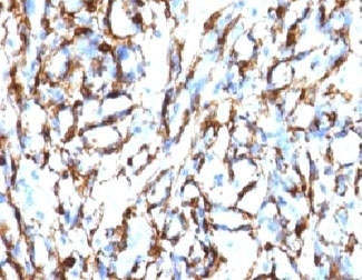 IHC testing of FFPE human angiosarcoma with Smooth Muscle Actin antibody (clone SMAT2-1). Staining of formalin-fixed tissues requires boiling tissue sections in pH 9 10mM Tris with 1mM EDTA for 10-20 min followed by cooling at RT for 20 min.~