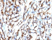 IHC testing of FFPE human angiosarcoma with Smooth Muscle Actin antibody (clone SMAT2-1). Staining of formalin-fixed tissues requires boiling tissue sections in pH 9 10mM Tris with 1mM EDTA for 10-20 min followed by cooling at RT for 20 min.