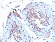 IHC testing of FFPE human testicular carcinoma with SHBG antibody (clone TTEB3). Staining of formalin-fixed tissues requires boiling tissue sections in 10mM Tris buffer with 1mM EDTA, pH 9, for 10-20 min followed by cooling at RT for 20 min.