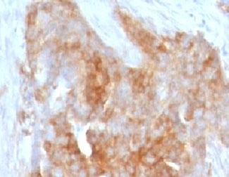 IHC testing of FFPE human ovarian carcinoma with Fascin antibody (clone FAN55-1). Staining of formalin-fixed tissues requires boiling tissue sections in pH 9 10mM Tris with 1mM EDTA for 10-20 min followed by cooling at RT for 20 min.