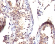 IHC testing of FFPE human testicular carcinoma with TGF alpha antibody (clone TFGFa-1). FFPE testing requires sections to be boiled in pH 9 10mM Tris with 1mM EDTA for 10-20 minutes, followed by cooling at RT for 20 minutes, prior to staining.