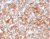 IHC testing of FFPE human renal cell carcinoma with CD147 antibody (clone CDLA147).